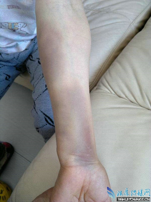 抽血后出现的手臂淤青是怎么
