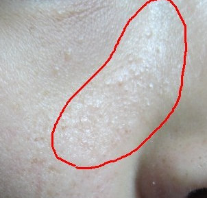 脑门上张闭口粉刺的原因是什么?脸上的闭口粉刺能挤吗?