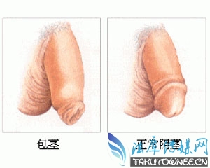 四岁男孩包茎图片,哪些国家婴儿出生直接割包皮?