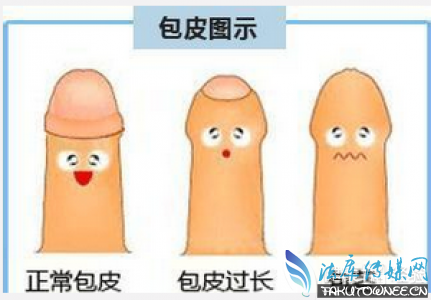 四岁男孩包茎图片,哪些国家婴儿出生直接割包皮?